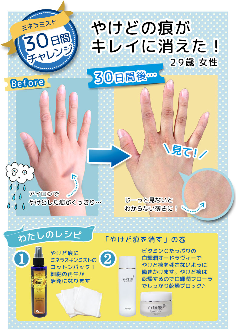 ミネラスキンミストBeforeAfter やけど